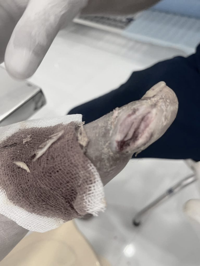 Điều trị vết thương mãn tính bằng PRF tại Cam Ranh