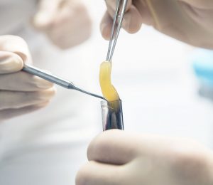 dieu-tri-vet-thuong-man-tinh-tieu-duong-bang-prf-giu-lai-ngon-chan-cho-benh-nhan-62-tuoi-2